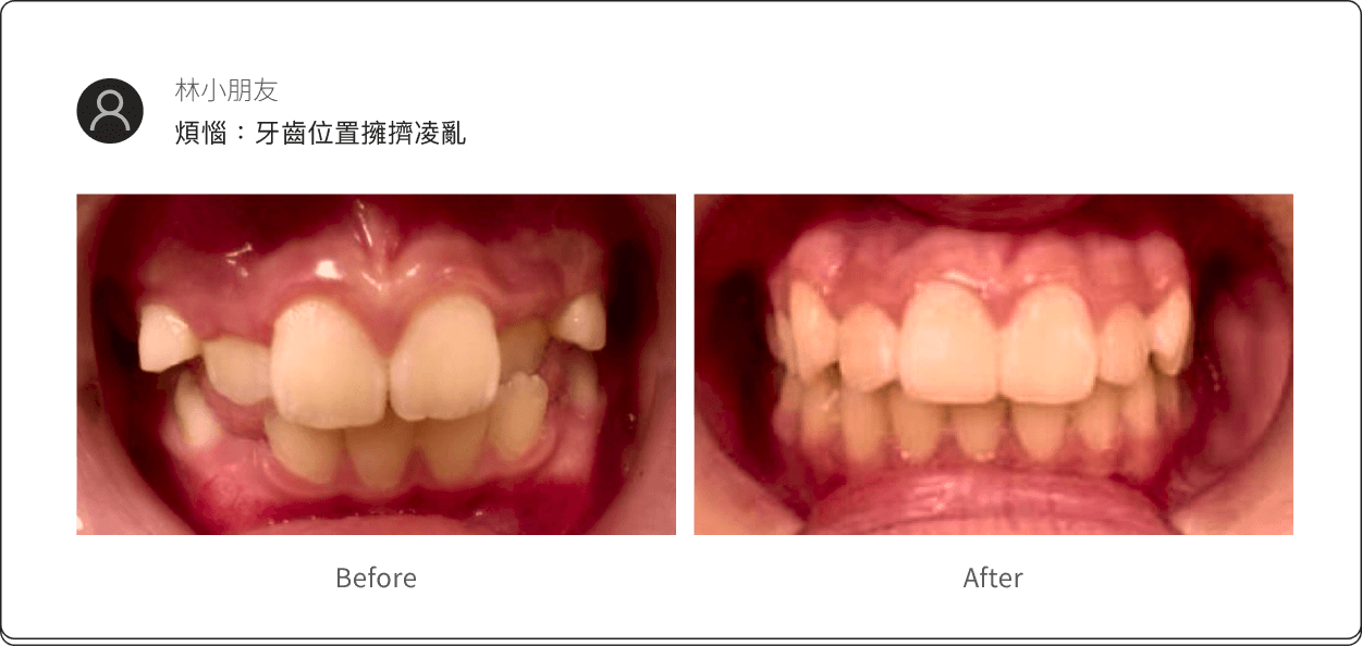 前牙蛀牙/變色